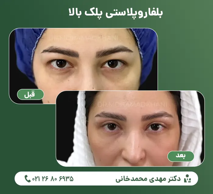Upper eyelid blepharoplasty-2