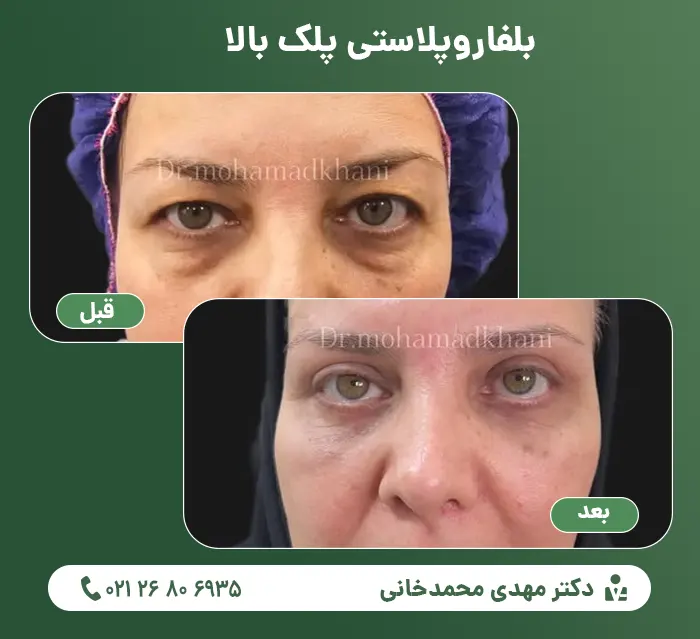 Upper eyelid blepharoplasty-3