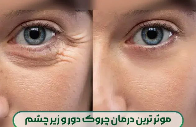 موثر ترین درمان چروک دور و زیر چشم