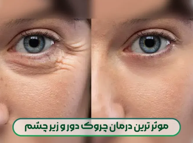 موثر ترین درمان چروک دور و زیر چشم