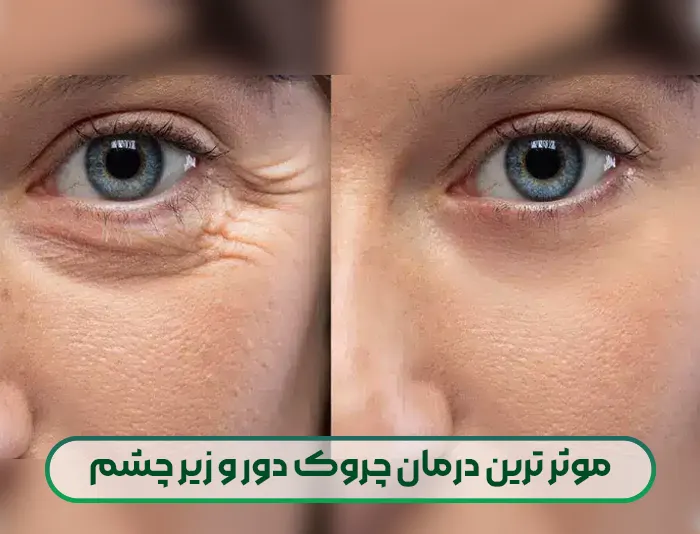 موثر ترین درمان چروک دور و زیر چشم