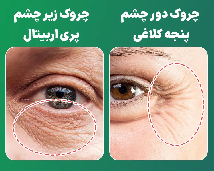 تفاوت چروک زیر و دور چشم