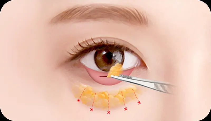 جراحی تخلیه چربی زیر چشم