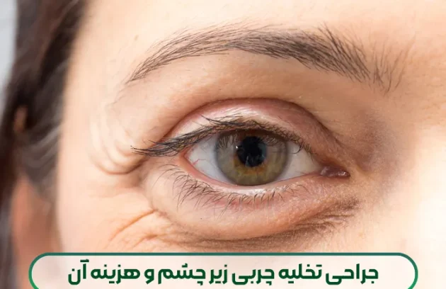 جراحی تخلیه چربی زیر چشم