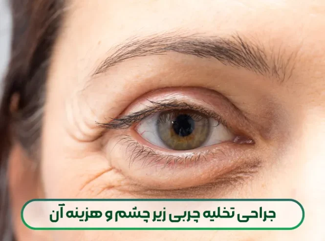 جراحی تخلیه چربی زیر چشم