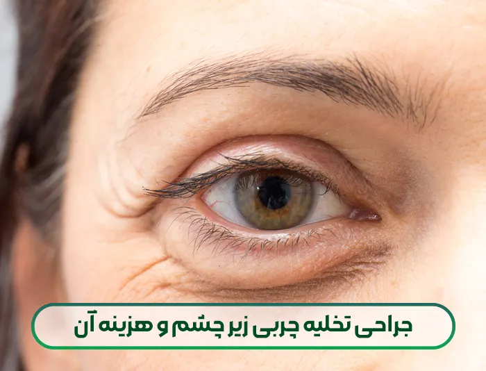 جراحی تخلیه چربی زیر چشم