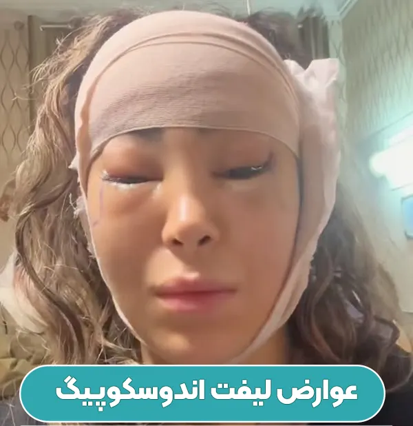 عوارض لیفت اندوسکوپیک