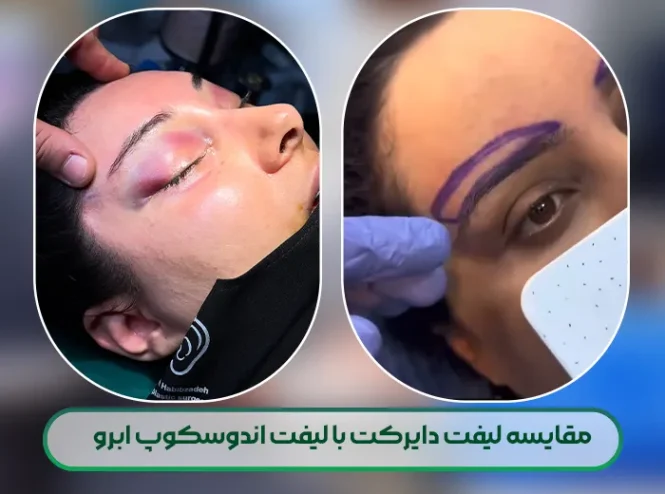 مقایس لیفت اندوسکوپیک ابرو با لیفت دایرکت ابرو