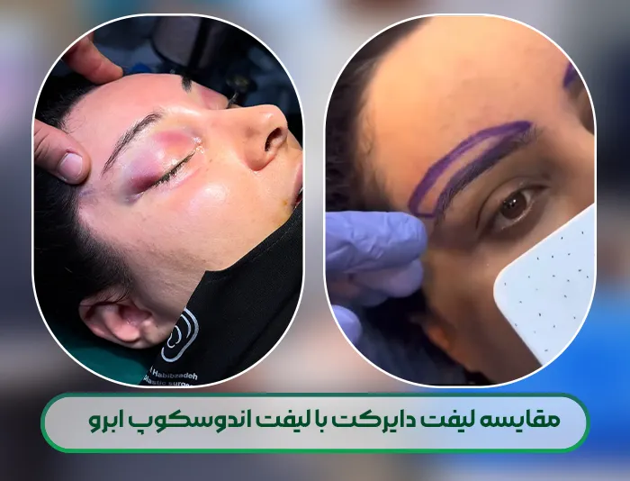 مقایس لیفت اندوسکوپیک ابرو با لیفت دایرکت ابرو