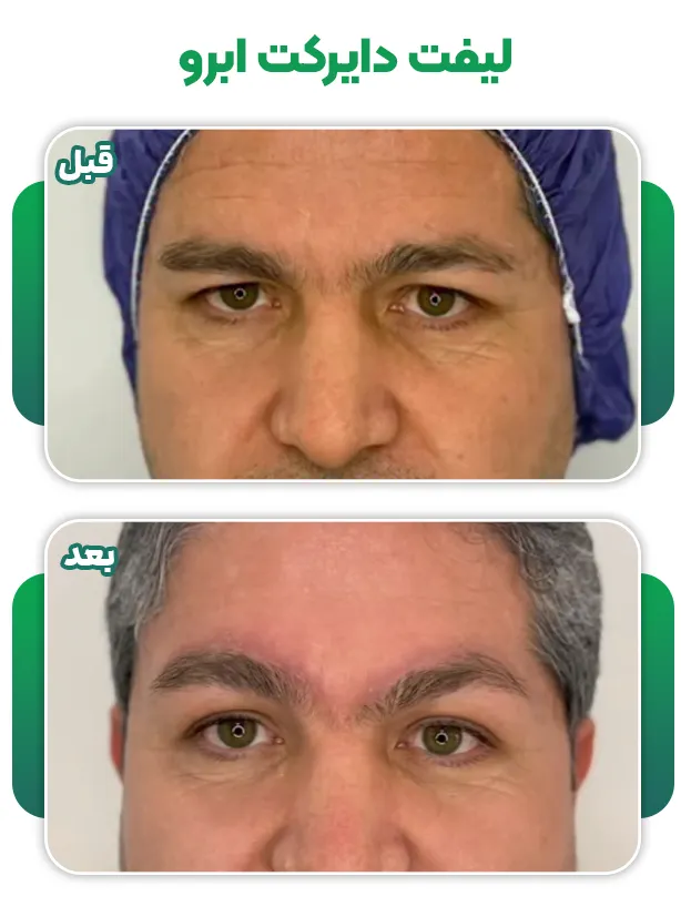 لیفت دایرکت ابرو