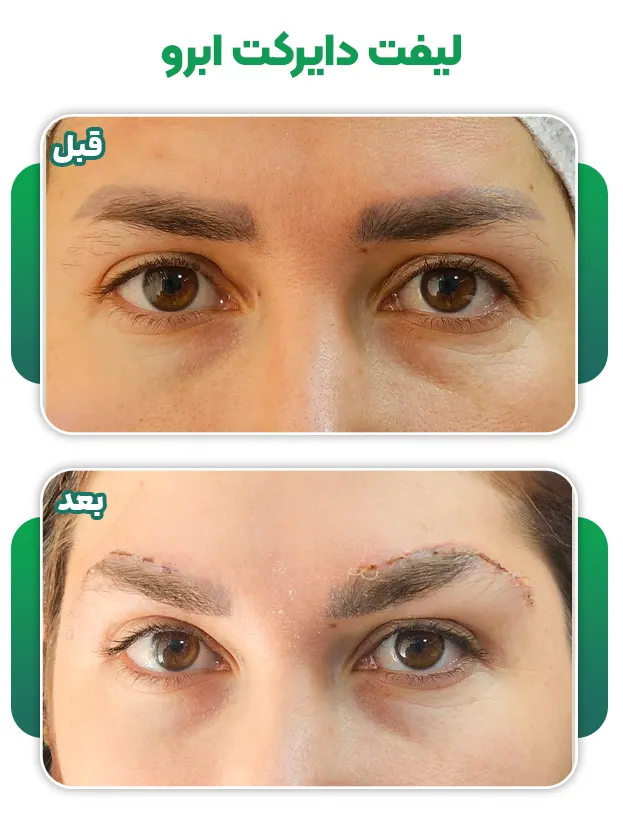 لیفت دایرکت ابرو