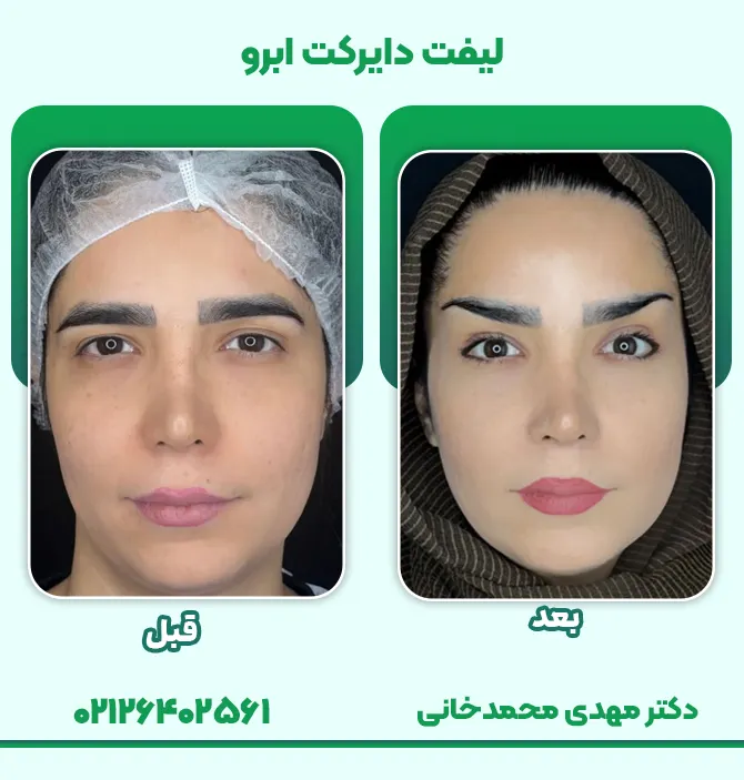 لیفت دایرکت ابرو