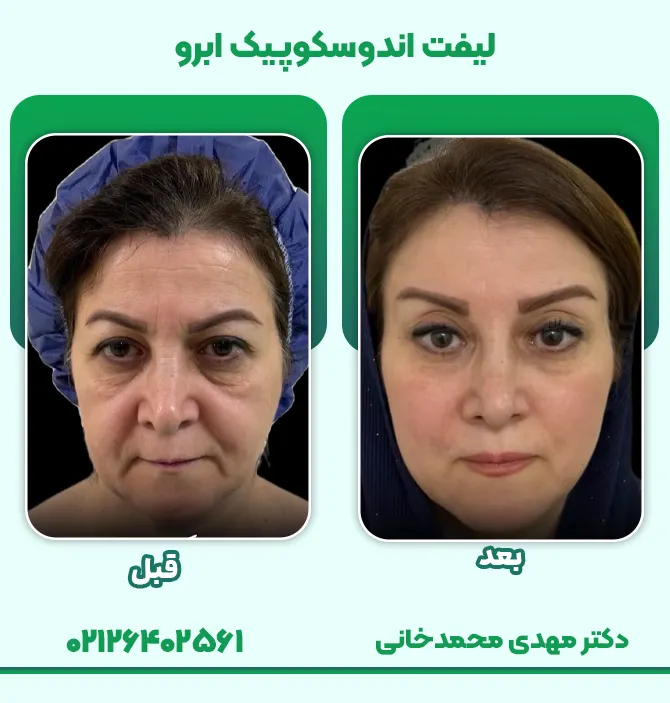 لیفت اندوسکوپیک ابرو