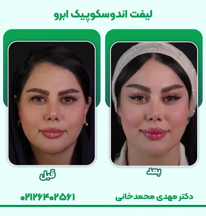 لیفت اندوسکوپیک ابرو