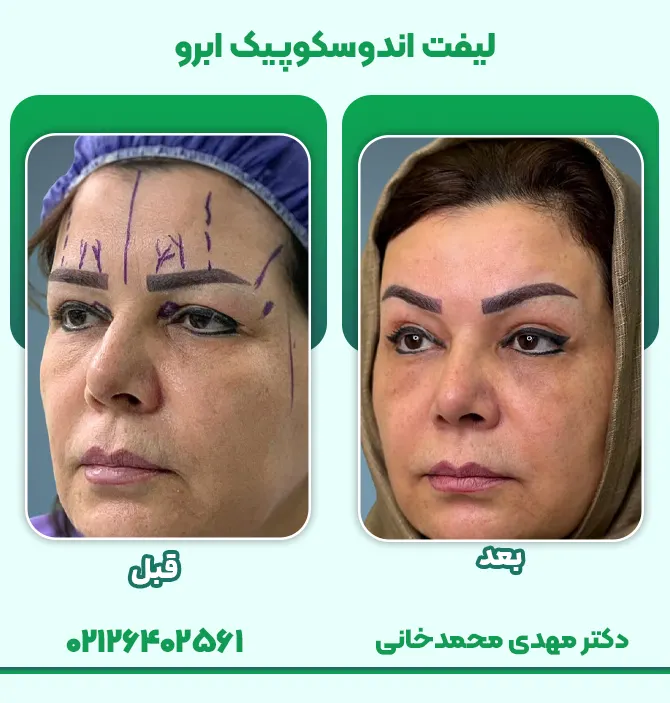 لیفت اندوسکوپیک ابرو