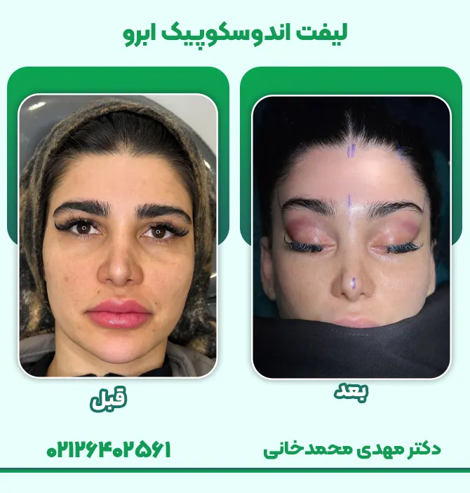 لیفت اندوسکوپیک ابرو