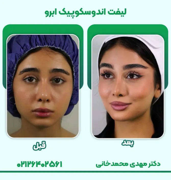 لیفت اندوسکوپیک ابرو