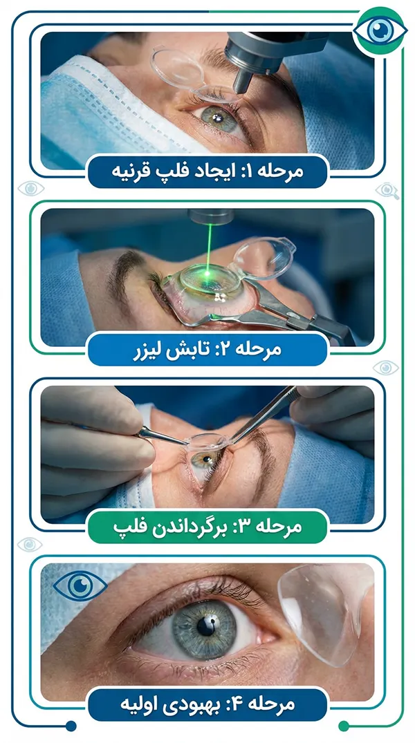 مراحل عمل لیزیک