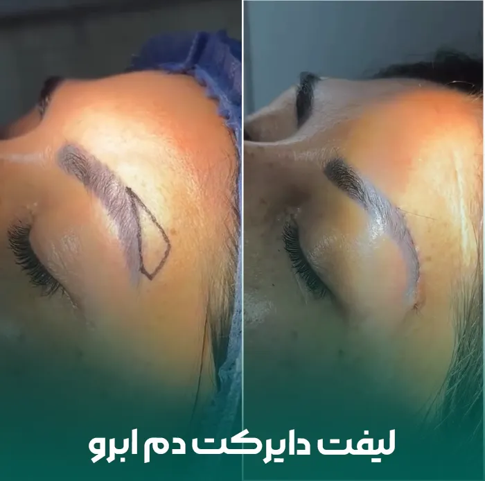 لیفت دم ابرو به روش دایرکت