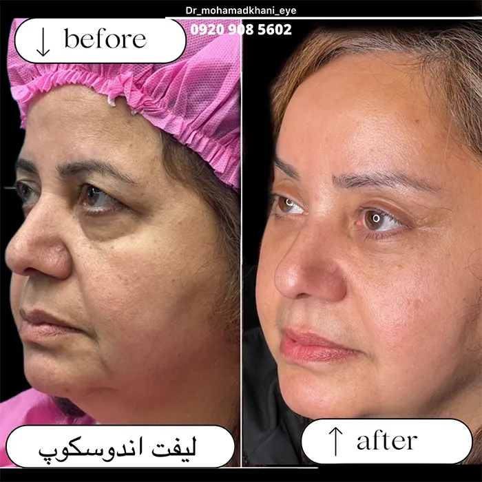 لیفت آندوسکوپیک شقیقه و ابرو