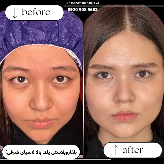 اپی کانتوپلاستی بلفارو پاک شرقی