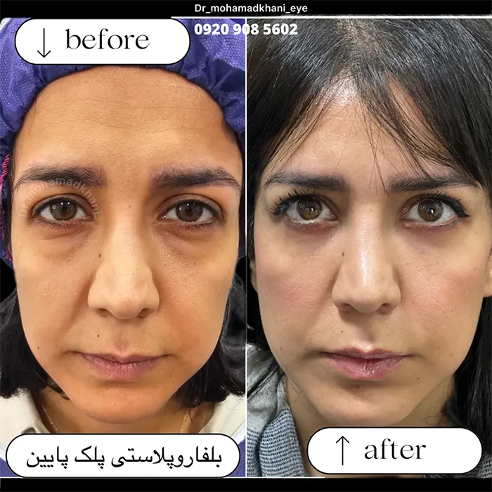 بلفاروپلاستی پلک پایین