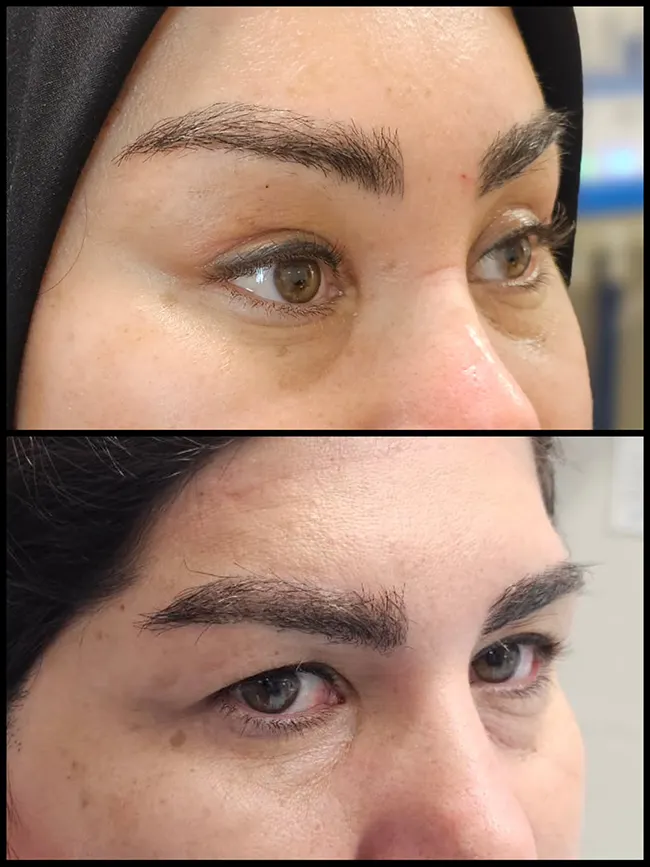 جراحی لیفت تمپورال