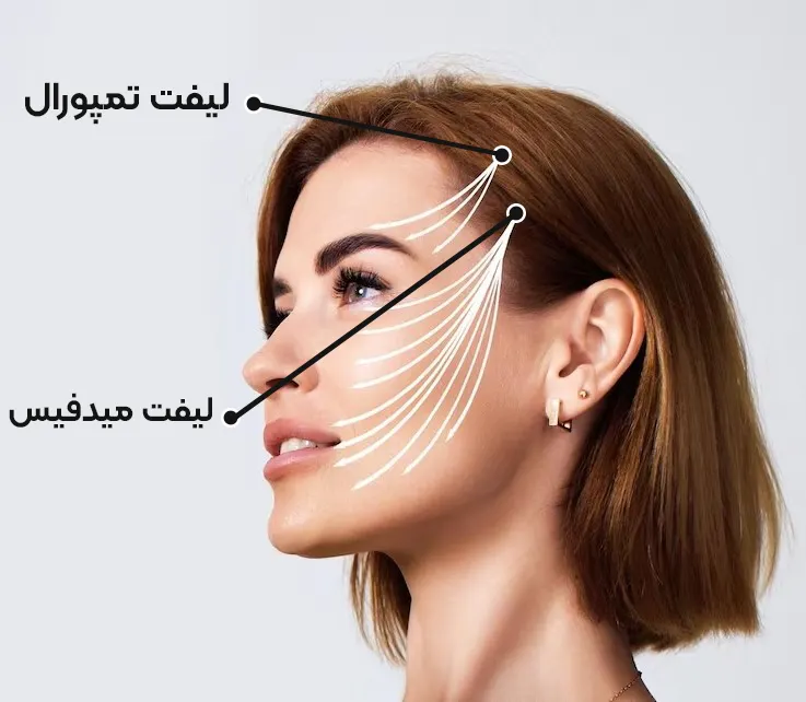 جراحی لیفت تمپورال