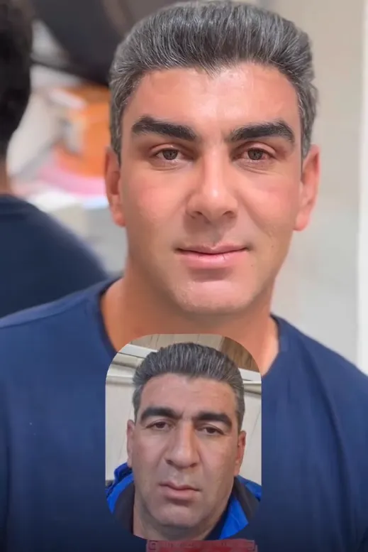 جراحی لیفت تمپورال