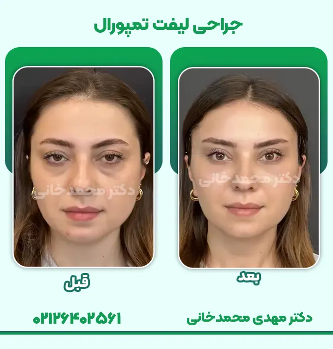 جراحی لیفت تمپورال