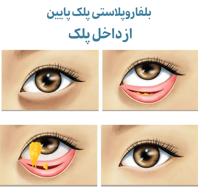 بلفاروپلاستی پلک پایین از داخل