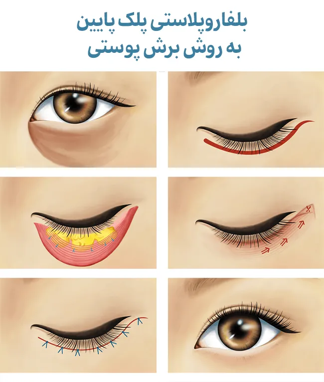 بلفاروپلاستی پلک پایین به روش برش پوستی
