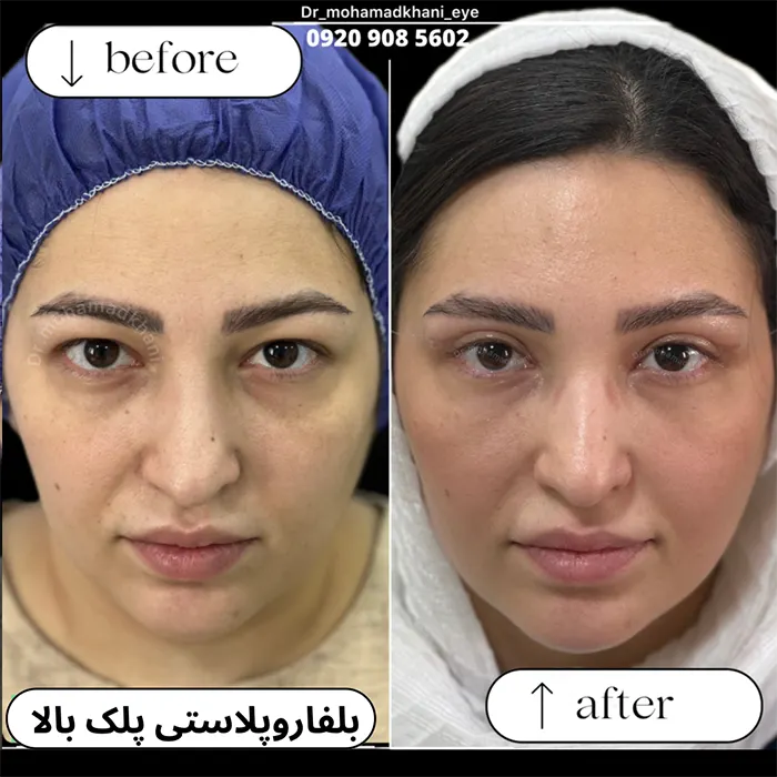 بلفاروپلاستی پلک بالا