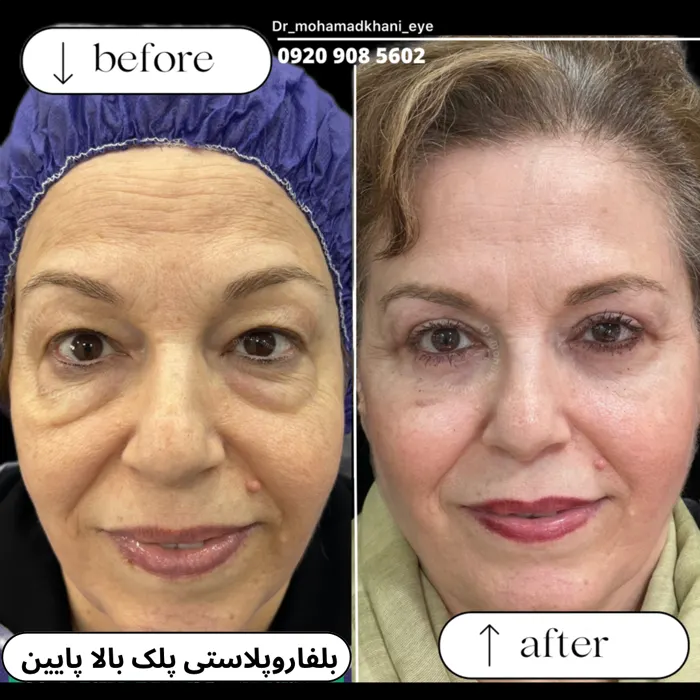 بلفاروپلاستی پلک پایین