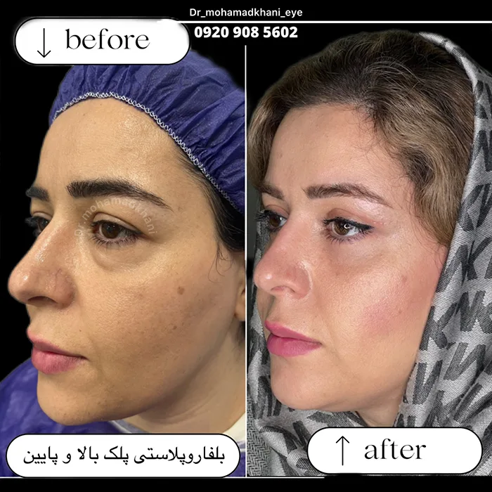 بلفاروپلاستی پلک پایین