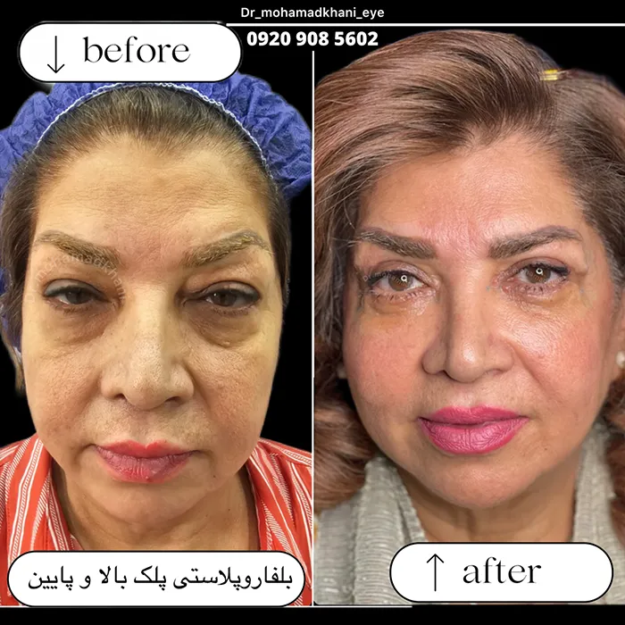 بلفاروپلاستی پلک پایین