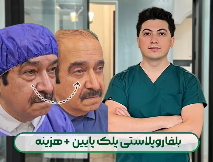 بلفاروپلاستی پلک پایین
