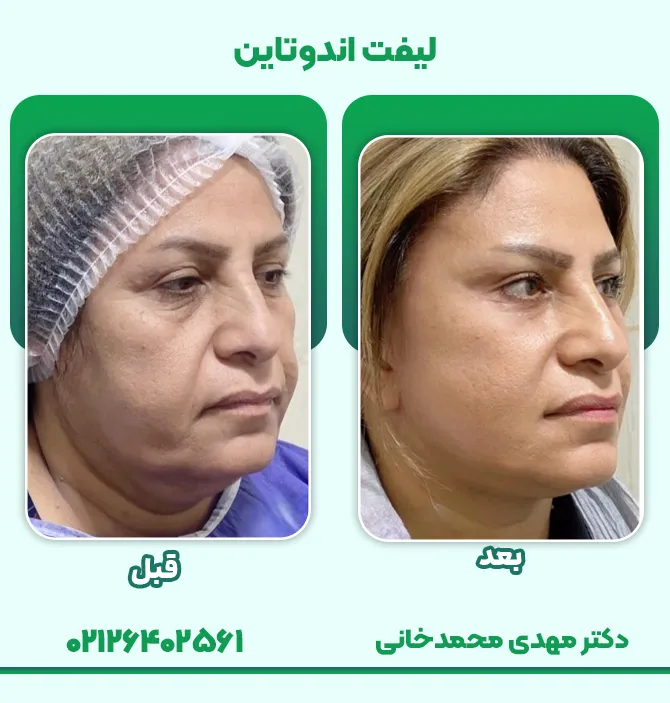 لیفت اندوتاین صورت