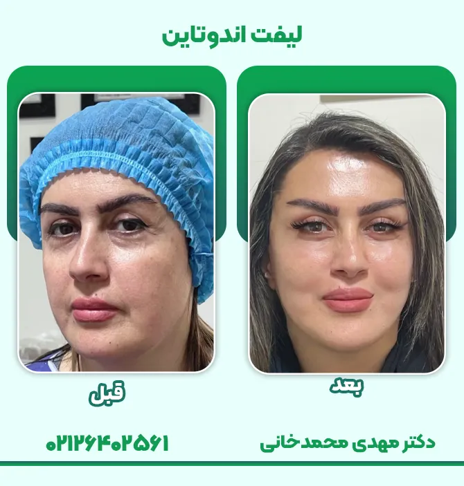 لیفت اندوتاین