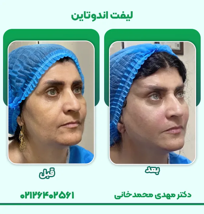 لیفت اندوتاین