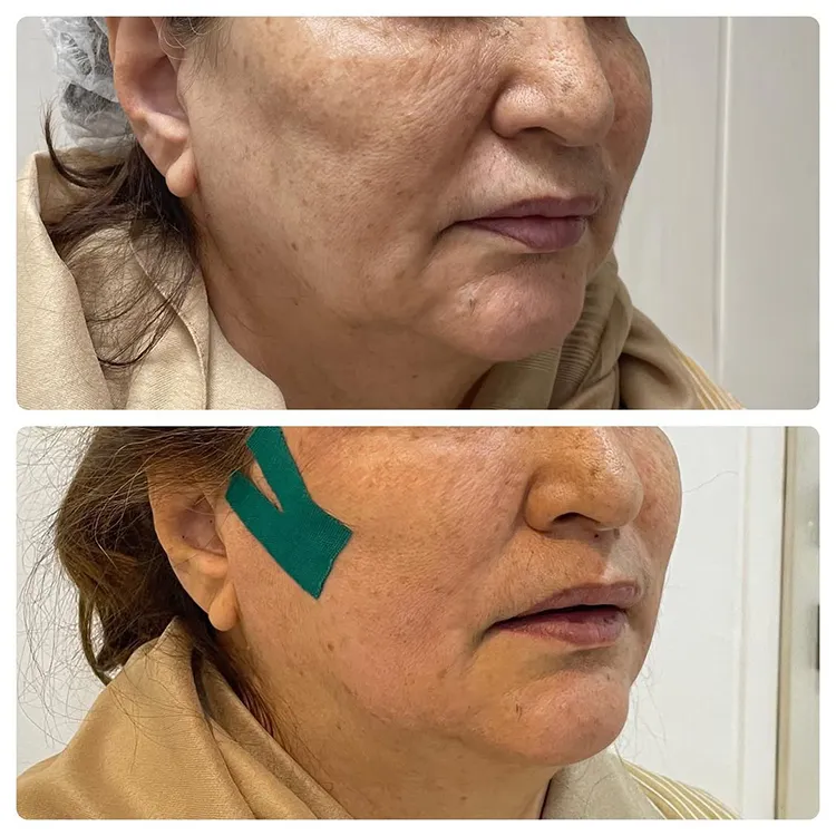 لیفت اندوتاین