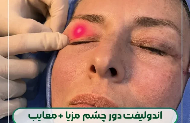 بررسی مزایا و معایب اندولیفت دور چشم