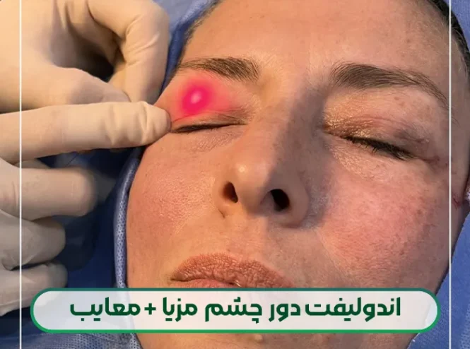اندولیفت دور چشم