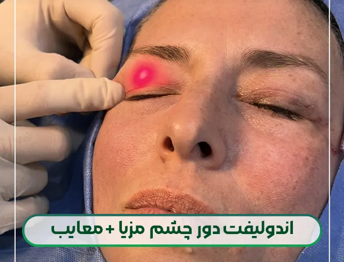 بررسی مزایا و معایب اندولیفت دور چشم