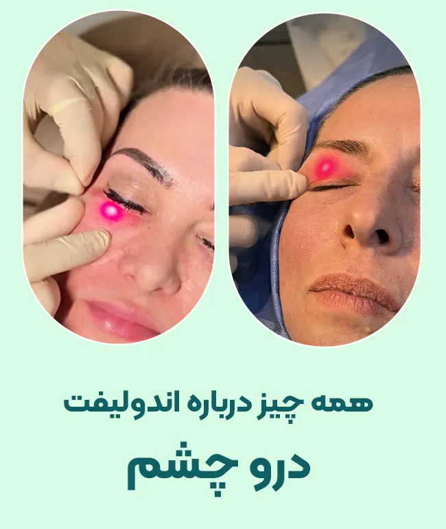 اندولیفت دور چشم