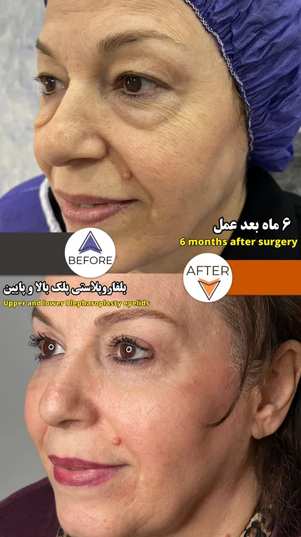 بلفاروپلاستی