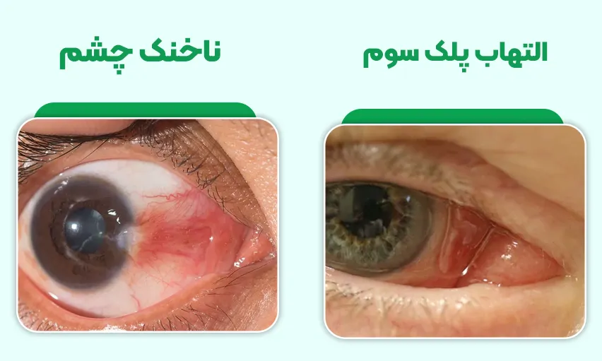 تفاوت بین ناخنک چشم و پلک سوم