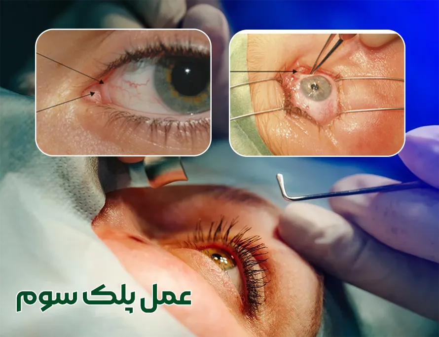 جراحی پلک سوم