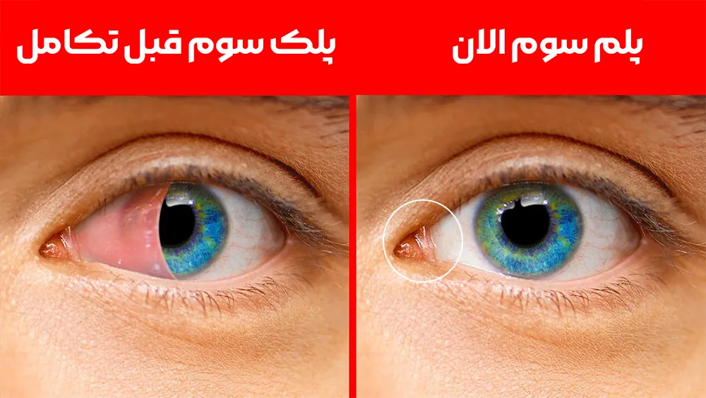 تاریخچه پلک سوم در انسان