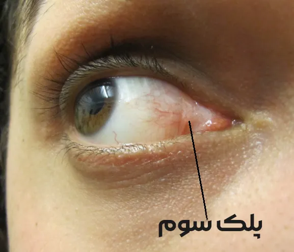 پلک سوم در انسان